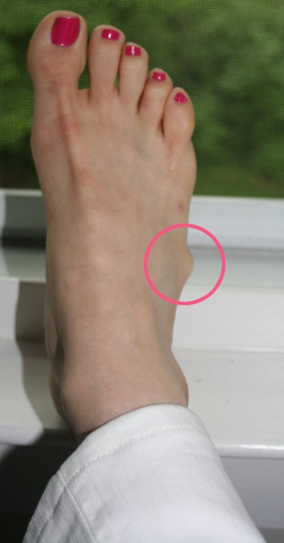 Ganglion Cysts On Feet Northwest Foot Care Dr Frank Cobarrubia Northwest Foot Care